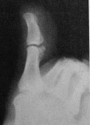 43: Calcaneus lateral radyogramı Ayak BaĢparmağı