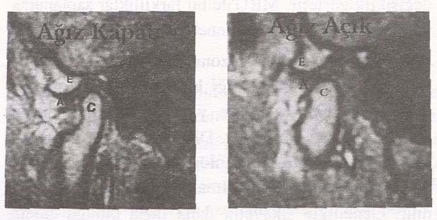 K.B.B. ve Baş Boyun Cerrahisi Dergisi, 2000, 8 (1) :66-70, bilgisayarda üç boyutlu hale getirilir (20).
