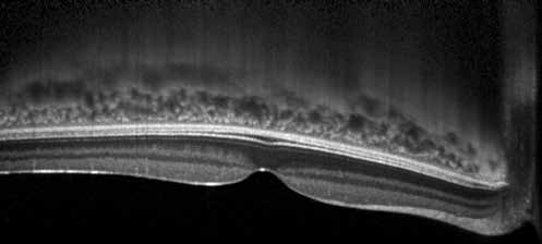 Turk J Ophthalmol 46; 1: 2016 OKT tekniğinde zero delay hattına yakın olan retina yapıları, uzak olanlara göre daha yüksek sinyallere sahip olduğu için retina ve vitreoretinal bileşkenin görüntüleri