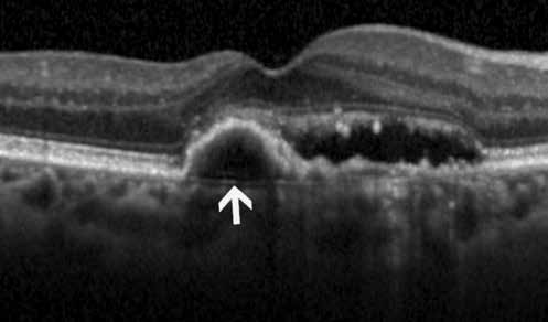 Foveanın altında koroidin en kalın olmasının sebebi foveadaki retina hücrelerinin yüksek oksijen gereksiniminin karşılanabilmesidir.