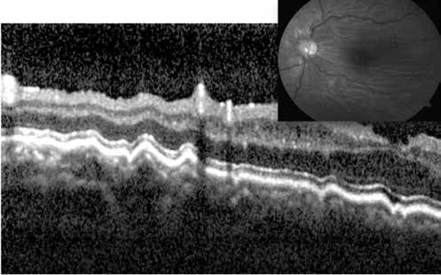 erkeklerde görülen bir hastalıktır. Hastalığın akut döneminde OKT de retina altı sıvı birikimi ve PED görülmektedir.