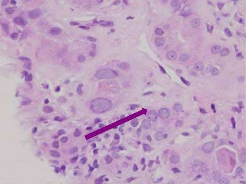 Tanı Renal Biopsi Alıcı böbrekte BKVN tanısı için altın standart Spesifitesi Tutulum fokal biyopsi normal olabilir (%35) Min 2 kor biyopsi alınmalı Renal tubul hücrelerinde: İntranükleer viral