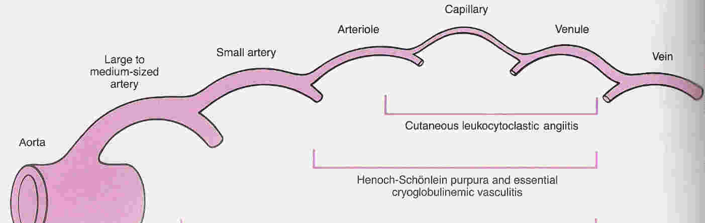 II. GENEL BİLGİLER Henoch-Schönlein purpurası, nedeni kesin olarak bilinmeyen, birden çok sistemi etkileyebilen, öncelikle deri, gastrointestinal sistem, eklem ve