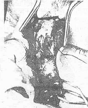K.B.B. ve Baş Boyun Cerrahisi Dergisi, 2000, 8(1):28-32, bir dönüş yaparak mediale doğru 6 mm kadar daha uzanıp ortak bir gövde de birleşerek lakrimal keseye açılırlar.