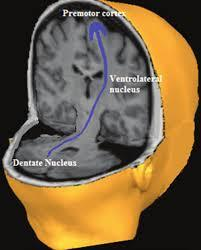 Sağ serebellum ve sol frontal korteks arasındaki dentato-talamokortikal yolların zarar görmesi