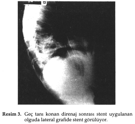 Tartışma İlk özofagus perforasyonu İ.Ö. 2500 de Edwin Smith papiruslarında servikal özofagokutaneal fistül gelişimi ile tanımlanmıştır.