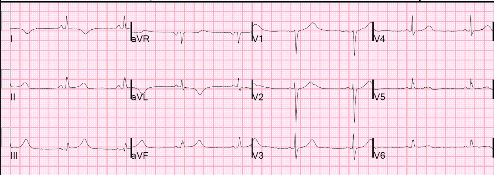 *Bir gün sonraki EKG DIII-aVF de geniş T dalgaları ve