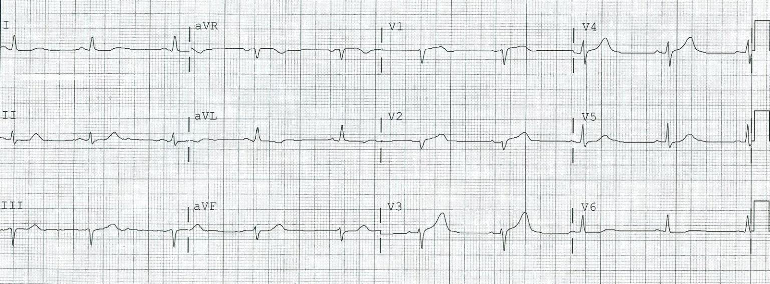 *EKG