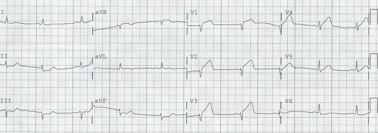 *EKG