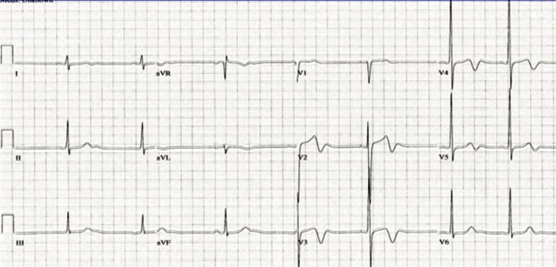 *EKG 4