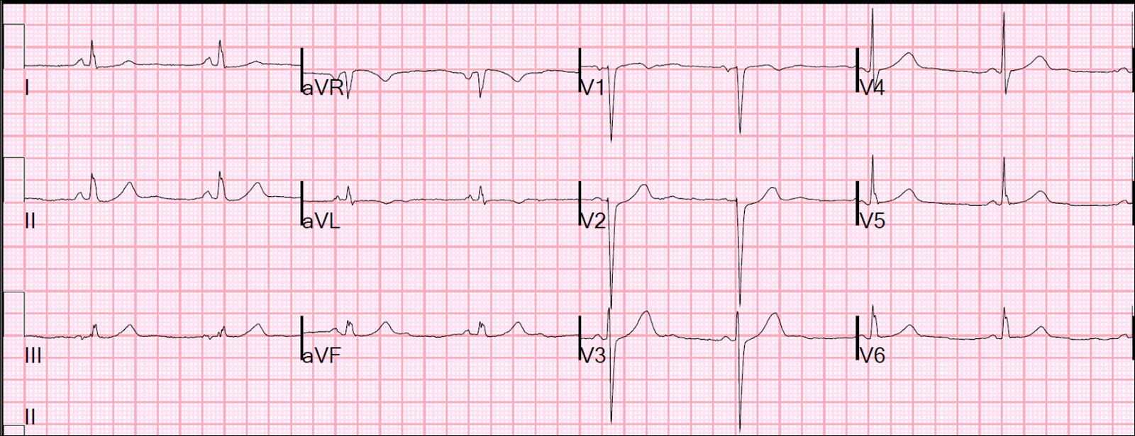 *42. dakika EKG si V5-6 daha düşük