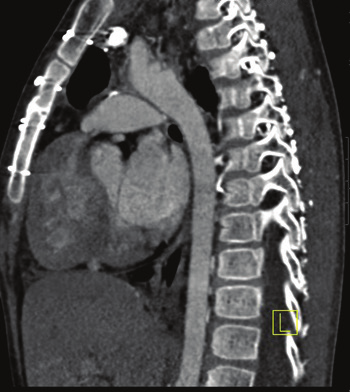 tipte ise azalmıştır. 1.Pulmoner atrezi Pulmoner atrezi tek başına olduğunda yaşamla bağdaşmaz; en azından PDA eşlik eder. Ek anomaliler araştırılmalıdır.