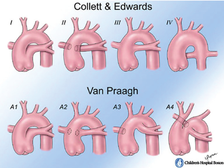 gerçekleşmesi gereken spiral trunkus bölünmesi gerçekleşmemiştir. Trunkus arteriyozusta tek bir arteriyel gövde kalpten çıkar ve sistemik, pulmoner, koroner dolaşımları sağlar.