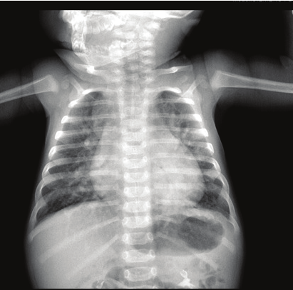 ) Resim 10: Direkt akciğer grafisinde kardan adam paterni Suprakardiyak TAPVD anomalisi Tartışma Siyanotik konjenital kalp hastalıklarda sistemik venöz kanın, akciğerlerde oksijenlenmeden direkt