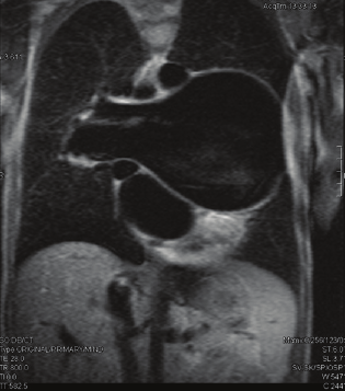 Resım 12: Oblik koronal kardiyak MR görüntülemede suprakardiak TAPVD anomalisi (pulmoner ven SVC ya dokulmektedir) Resim 14: Kardiyak MR görüntülemede