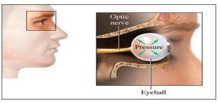 Genellikle optik sinir (göz siniri) hasarına sebep olan yüksek göz basıncıdır. Bazı durumlarda, glokom normal göz basıncının varlığında da meydana gelebilir.