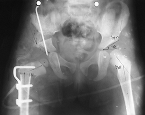 A: Femur başı ile iskiumun dış kenarı arasındaki mesafe (5