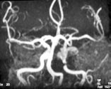 [23,24] Son y llarda kontrast madde TOF- MRA n n sorunlar ndan bir bölümünü çözmek amac ile kontrastl 3D-TOF-MRA ve dinamik kontrastl subtraksiyonlu MRA fleklinde serebral damarlara uyarlanarak