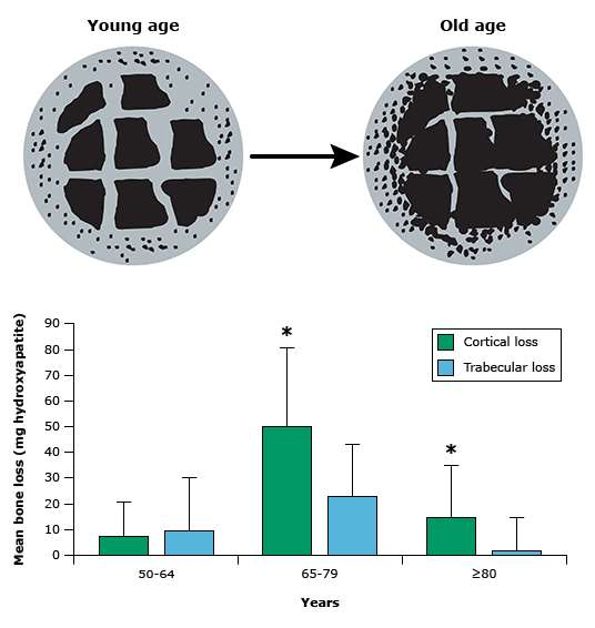 Yaş ile ilişkili osteoporoz >45 yaş,