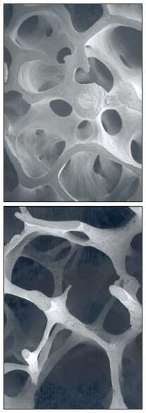Osteoporoz Düşük kemik kütlesi Mikroyapıda bozulma Kemik