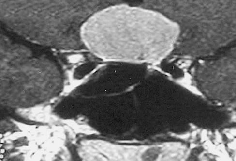 2D 2A Şekil 2: T1 ağırlıklı post kontrast A) sagittal incelemede homojen kontrast tutulumu gösteren anteriorda tipik dural kuyruk bulgusu olan düzgün