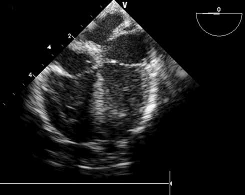 Turk Gogus Kalp Dama Şekil 1. Kor triatriatum sinistrum tanılı bir hastada fibromusküler membranın transözofageal ekokardiyografi ile görüntülenmesi.