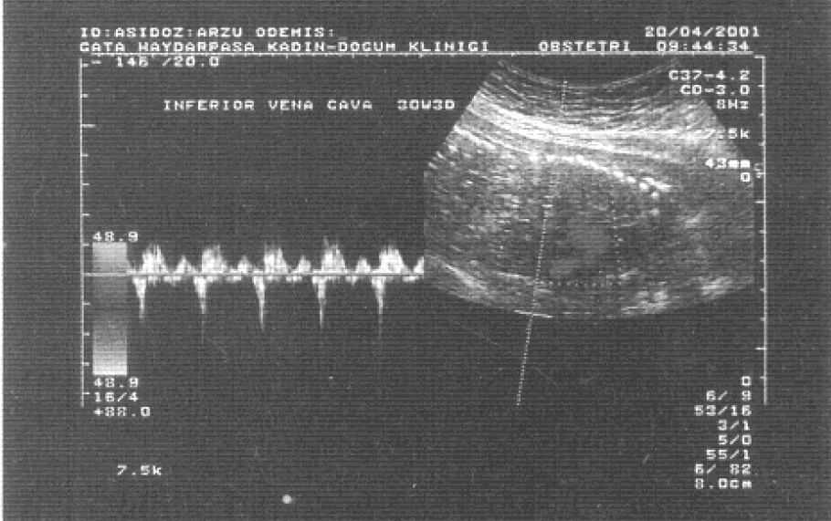 haftalar aras ndaki UGR fetuslarda optimum do um zaman n n belirlenmesinde önemli rol oynayabilir. Resim 1. Normal vena cava inferior ak m h z dalga formu. Resim 2.