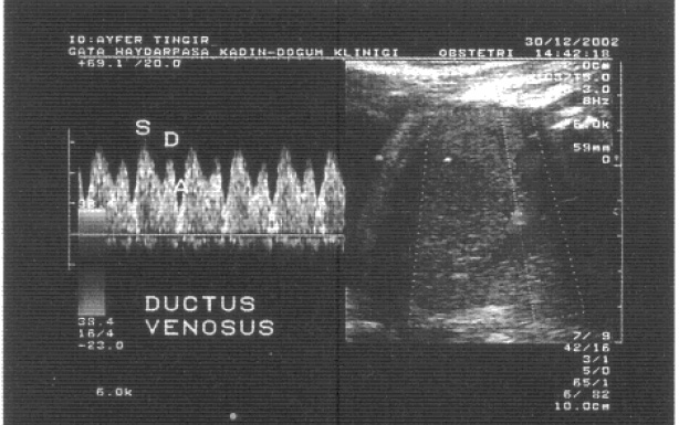 8 Resim 3. Normal ductus venosus ak m h z dalga formu. beten yüksek ak m h z, onun çevre damarlardan kolayca ay rdedilmesini sa lar (19).