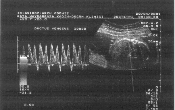 Normal flartlarda DV daki kan ak m tüm kalp siklusu süresince ileri do ru ve bifazik karekterdedir.