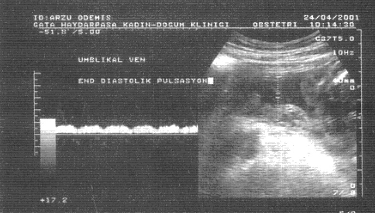 Tulzer ve ark. n n çal flmas nda, nonimmün hidrops fetalisi olan fetuslarda venöz pulsasyonlar n varl nda mortalite önemli ölçüde artm fl bulunmaktad r (34).