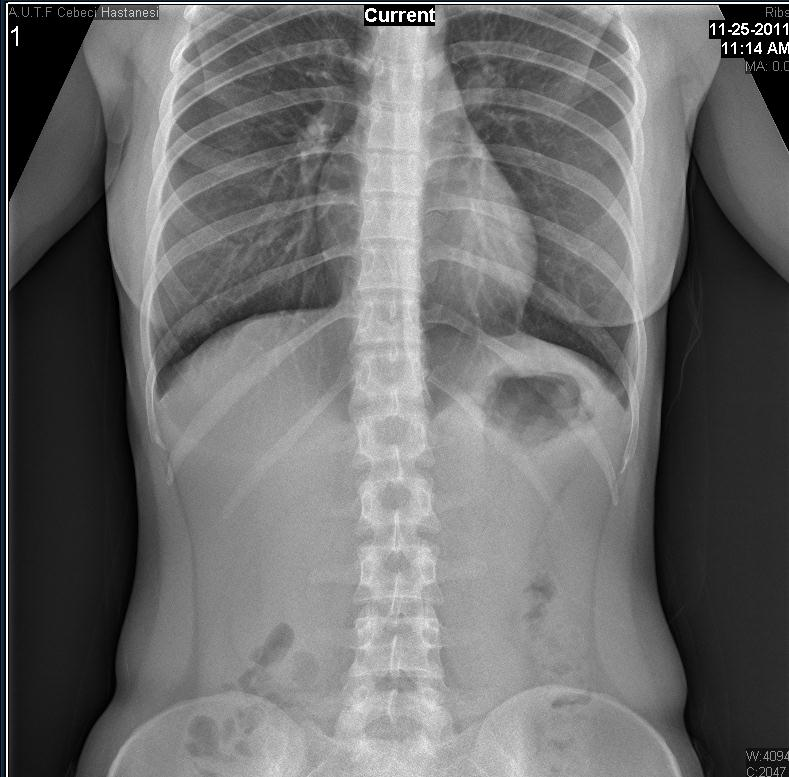 Uygun doz Trakeal hava sütünu izlenir Orta torakal vertebra disk