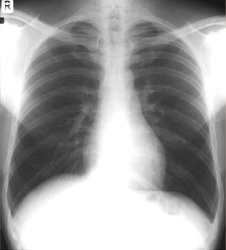 Mediasten çıkan aorta SVC arkus aorta pulmoner konus AP