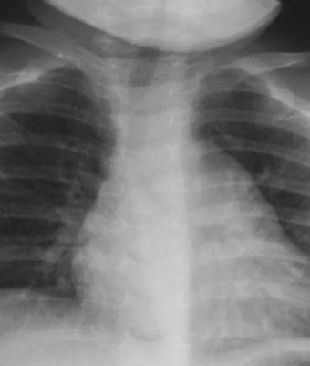 Hiluslar Başlıca pulmoner a Sol pulmoner arter daima