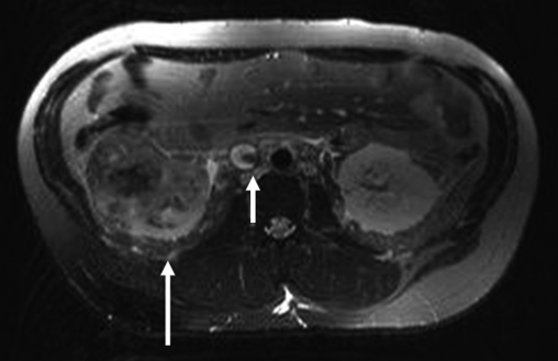 A A Şekil 3. A: Venöz Faz T1 ağırlıklı renal MRG incelemesinde sağ böbrekteki RCC ye sekonder sağ renal vende inferior vena kavaya uzanan tümör trombüsü izlenmektedir.
