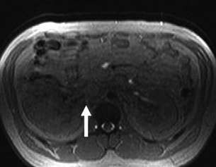 Renal fonksiyonları yetersiz olan hastalarda ve renal kitle nedeni ile opere olan hastaların takibinde, operasyon sonrası renal yetmezlik riski bulunduğundan MRG ile hastaların takip edilmesi önem