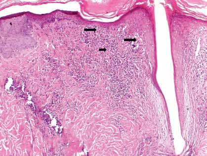 Geç dönemde papiller ve retiküler dermiste fibrozis, özellikle de follikülün üst bölümlerinde konsantrik lamellar fibrozis gelişir 7,9.