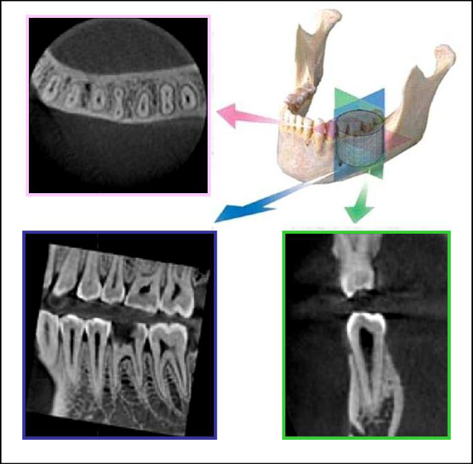 bir rekonstrüksiyon zamanı sonrasında görüntüsü alınan bölgenin X (dental arka paralel düzlem=sagital), Y (dental arka dik düzlem=koronal), Z (vücut eksenine dik düzlem=aksiyel) düzlemlere ait