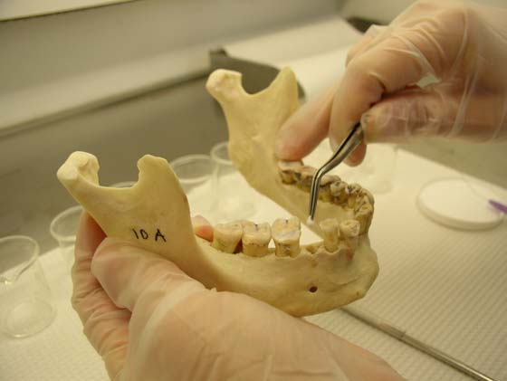 Dişlerin uzaklaştırılmasını takiben yaklaşık 2 mm çapında hazırlanan pamuk