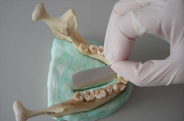 2.3. Radyografik Teknik: Komşu dişlerle aproksimal temasta olacak şekilde alveoler sokete yerleştirilen dişler ve dişleri taşıyan kadavra mandibulalar silikon kalıplar içine gömüldü ve bu kalıp