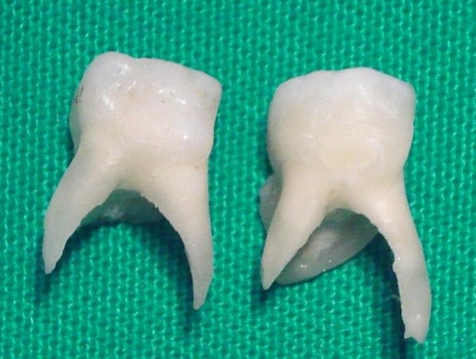 Restorasyon kenarlar 2 mm aç kta kalacak ekilde tüm di yüzeyleri ve akril ile birle im bölgeleri iki kat t rnak cilas ile izole edildi. %0.