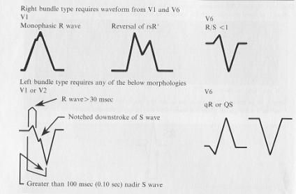 74 yaşında erkek göğüs ağrısı ve çarpıntı Cevap: VT hız 170 QRS komleksleri önünde retrograd P dalgaları ve QRS kompeks morfolojisi temelinde sağ sal bloklu