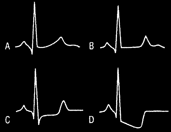 dalgas derin negatif olup, Q dalgas olmufltur (V 2-3 deki yüksek R dalgas karfl t ). 5.