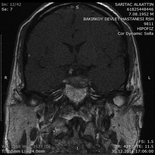 A:T ağırlıklı kontrastlı sagittal MR görüntüleme, B: T ağırlıklı kontrastlı koronal MR görüntüleme. Resim 4. Ameliyat sonrası.