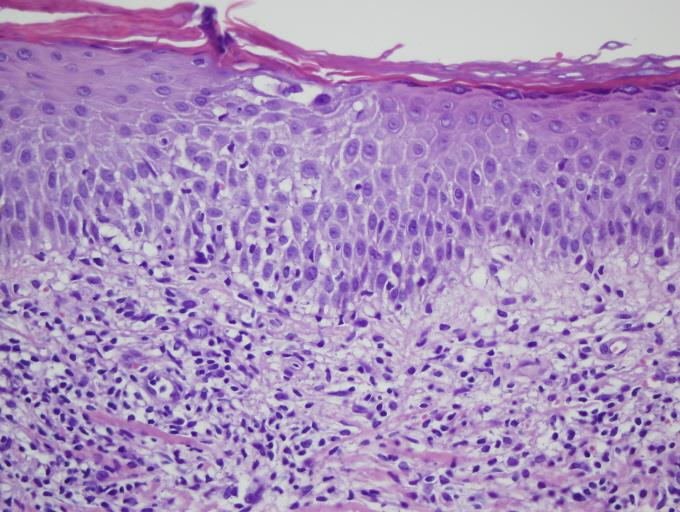 Epidermis İnflamatuar ve deri eki hücreler epiteliyal yapılarında