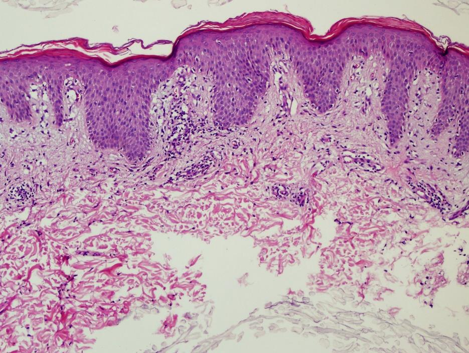 Derin tür süperfisyel ve derin vasküler pleksus tutulumu vardır (lenfositik vaskülit paterni) Epidermis sıklıkla normaldir, birkaç nekrotik keratinosit ve bazal vakuoler değişiklikler olabilir Lupus