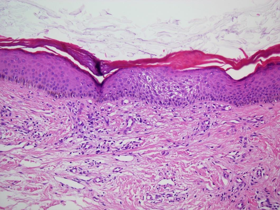 TANISAL İPUÇLARI Epidermis: Hafif spongioz,