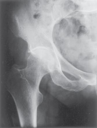Example Hip Implant With age or certain