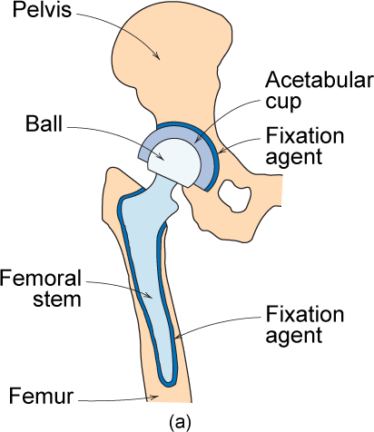 Example Hip