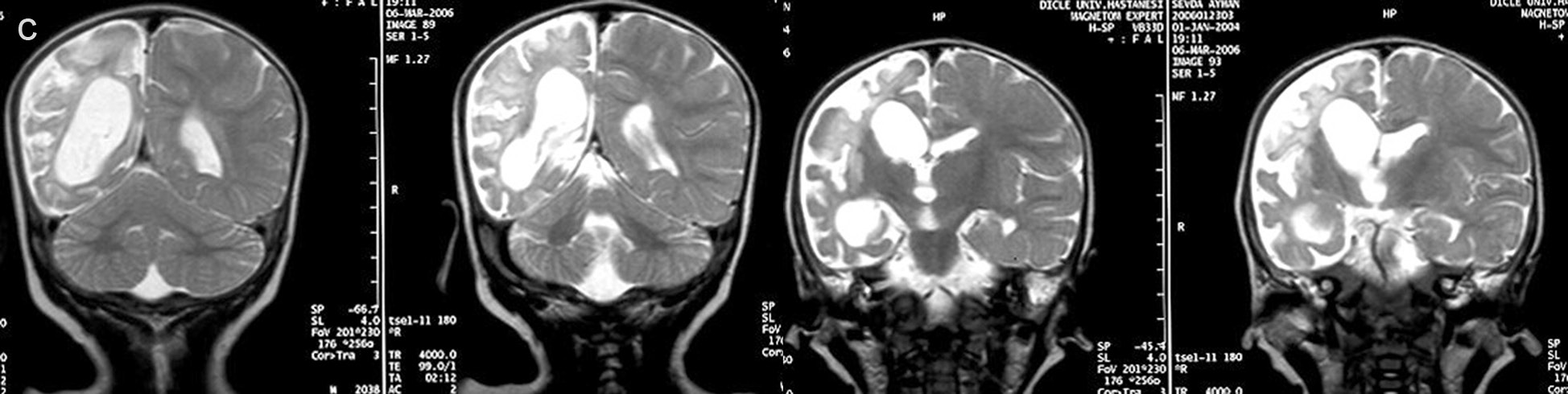 Olguların 13 tanesinde (%81) serebral atrofik bulgulara eşlik eden T2 ve FLAIR sekanslarında hiperintens gliotik sinyal değişiklikleri mevcut olup, 4 olguda (%25) bilateral ve 9 olguda (%56)