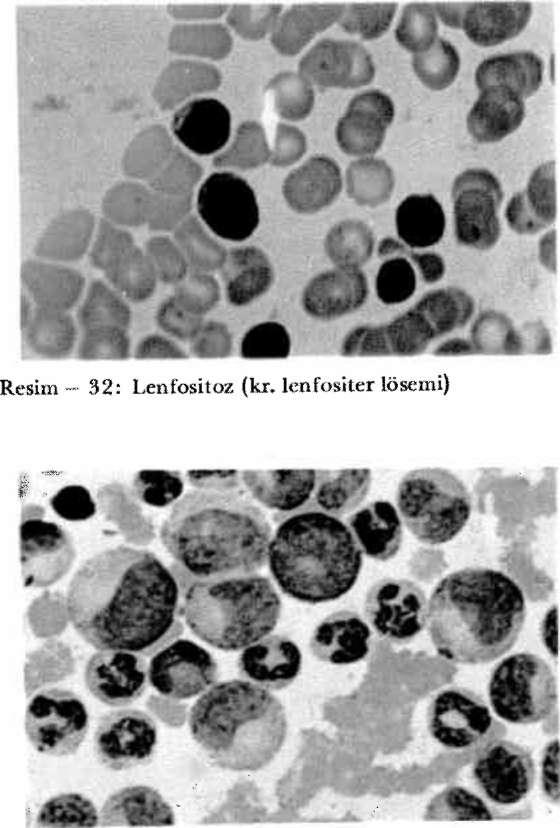 35: Lenfoblastlar (A.